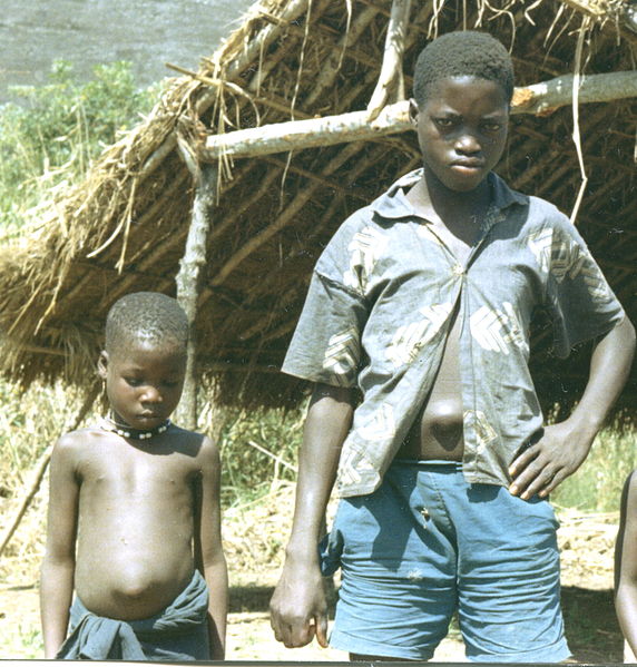Children with umbilical hernias