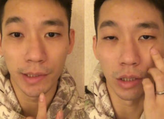 Chan Peng Soon reveals he has Bell's Palsy. (photo: Chan Peng Soon's Facebook)
